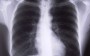 Pneumonia é a doença que mais mata crianças