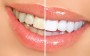 Higiene e clareamento dos dentes – Como funcionam?