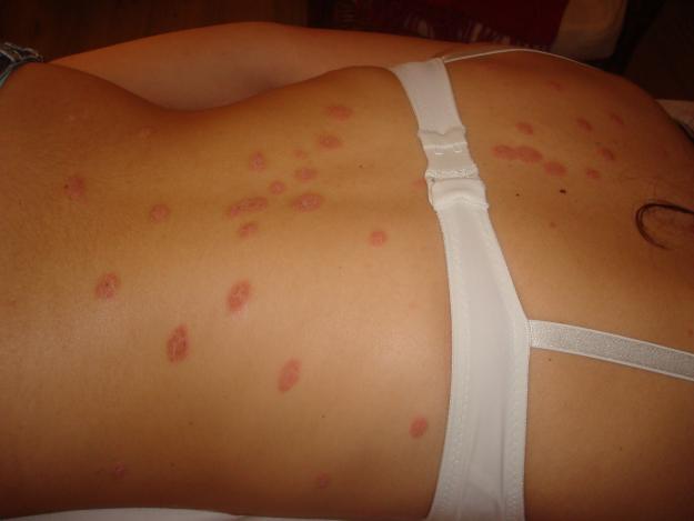 Psoriase Doença