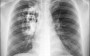 5 curiosidades sobre câncer de pulmão