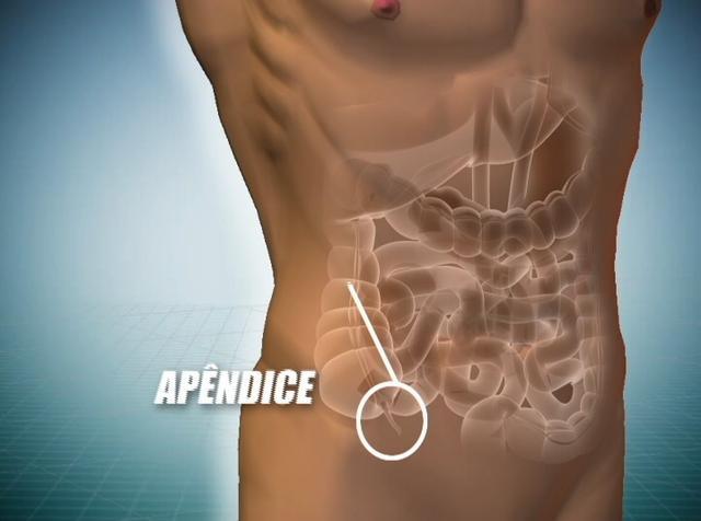 Sintomas da apendicite