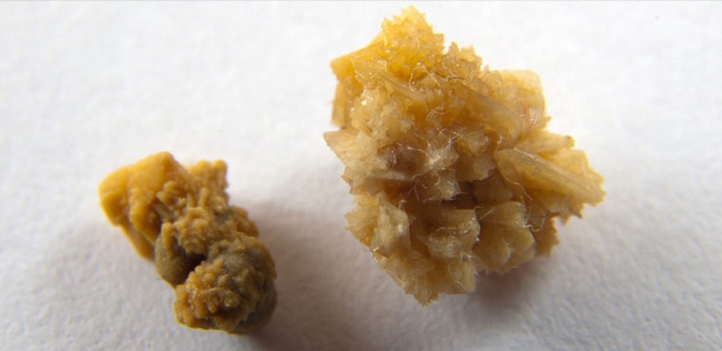 Cálculos de cistina