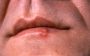Herpes bucal: um mal que atinge 85% da população brasileira