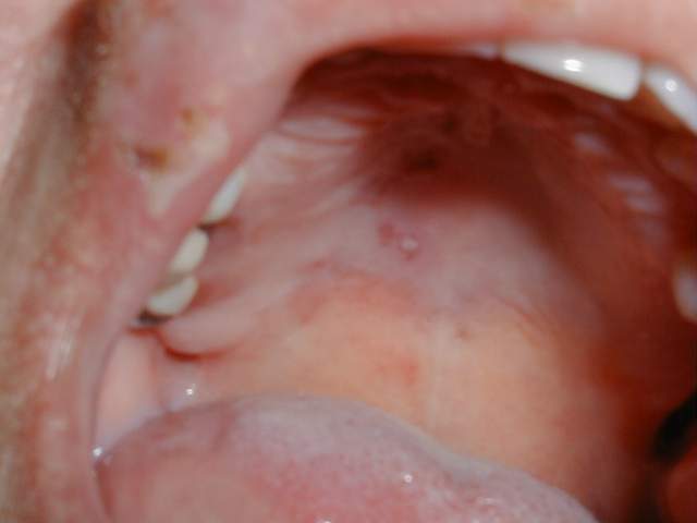 Herpes Zóster uma das variáveis mais complicadas da doença