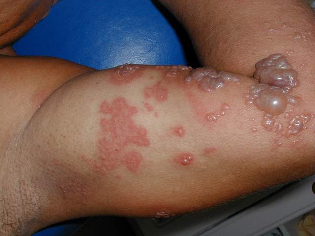 Herpes Zóster - uma das variáveis mais complicadas da doença